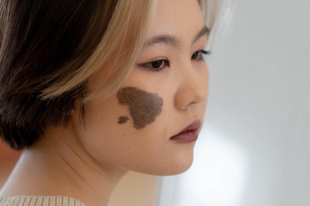 Is Birthmark Removal Safe for Sensitive Areas