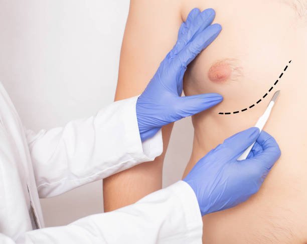 Is Gynecomastia Surgery a One-Time Fix