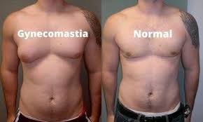 Male breast reduction in islamabad