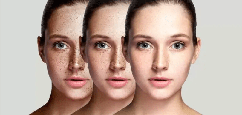 Melasma Treatment: How to Choose the Right Option for You