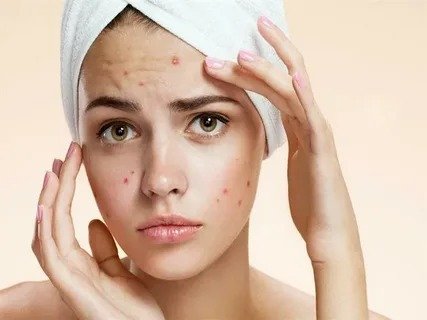 Pimples Treatment in Dubai