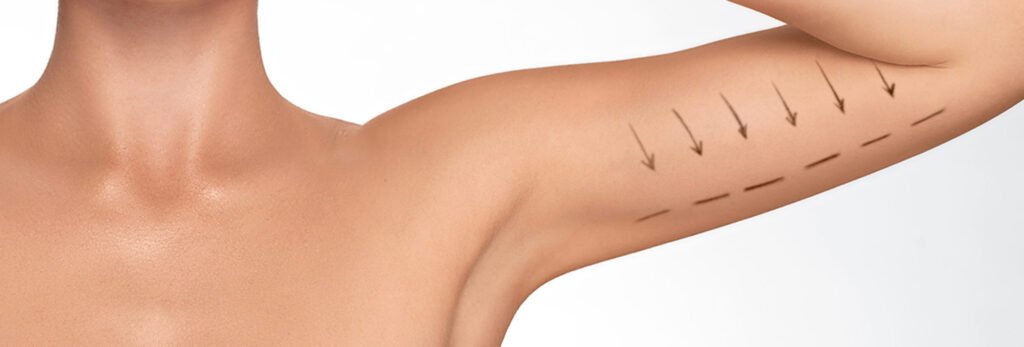 Reclaim Youthful Arms with Expert Arm Lifts