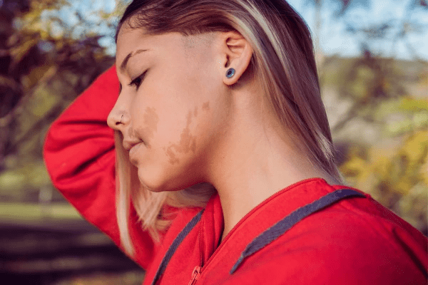 Does Birthmark Removal Treatment Minimize Redness?