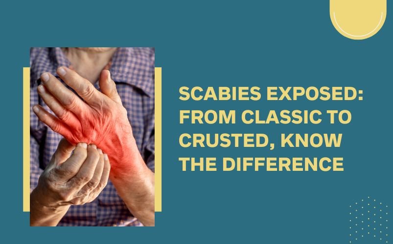 Scabies Disease