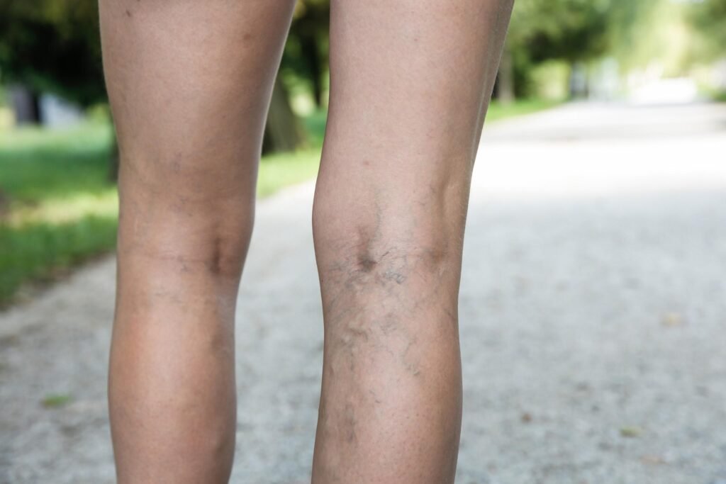 Why Choose for Your Sclerotherapy Treatment