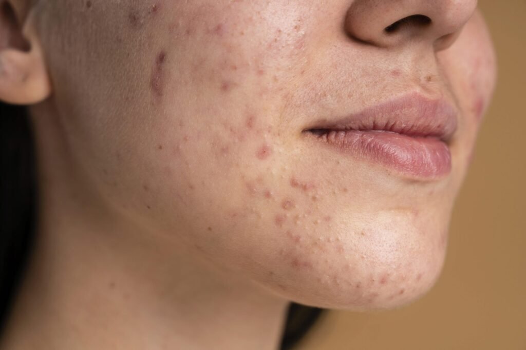 Acne Treatment in Dubai