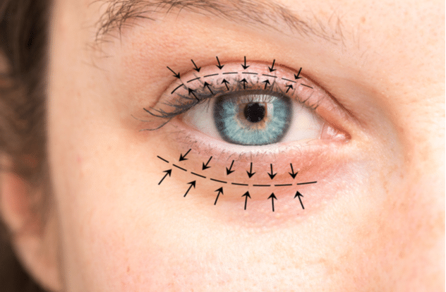eyelid surgery in riyadh