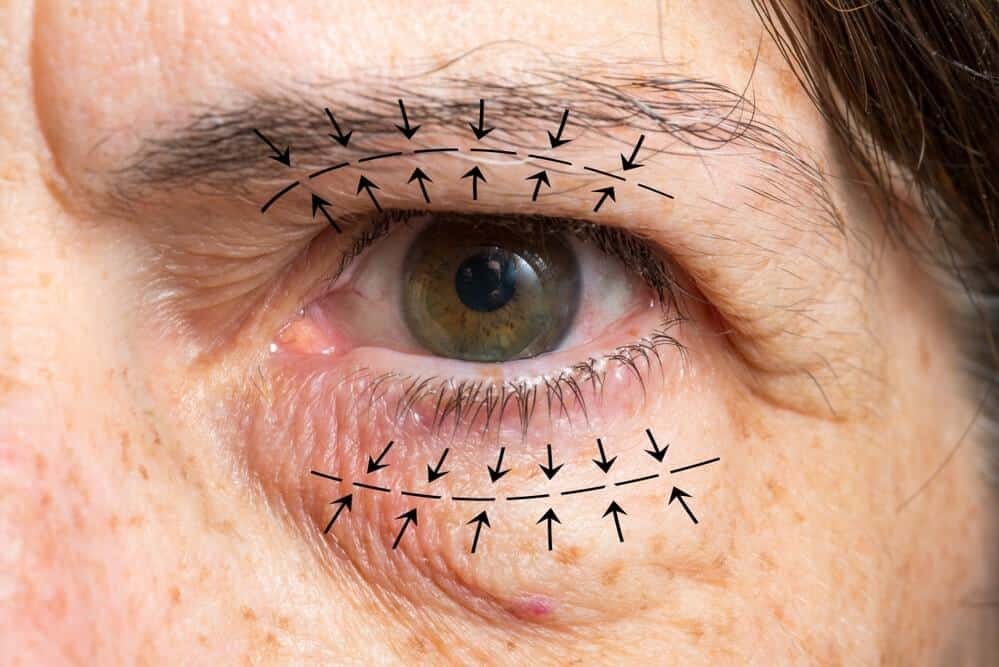 eyelid surgery