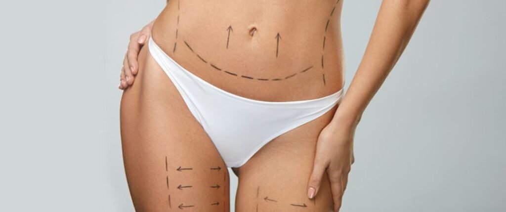 liposuction