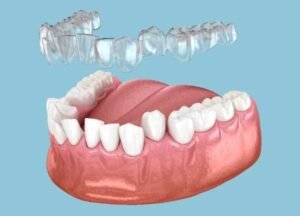 Invisalign