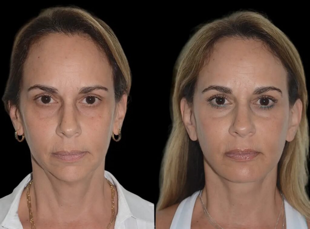 Chin Fillers in Dubai