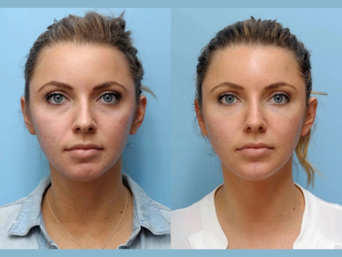 Benefits of Choosing Thread Lift in Dubai for Facial Contouring
