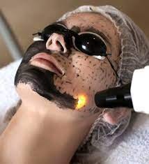 What to Expect During and After a Spectra Carbon Peel Session?