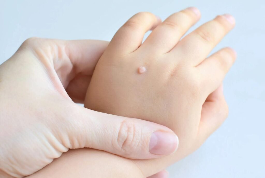 Warts Removal In Dubai