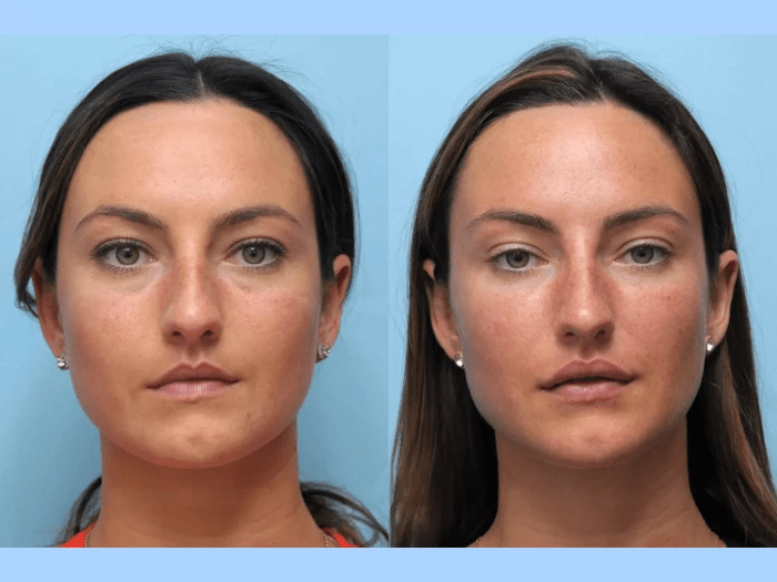Thread Lift in Dubai: Real Results, Real Confidence